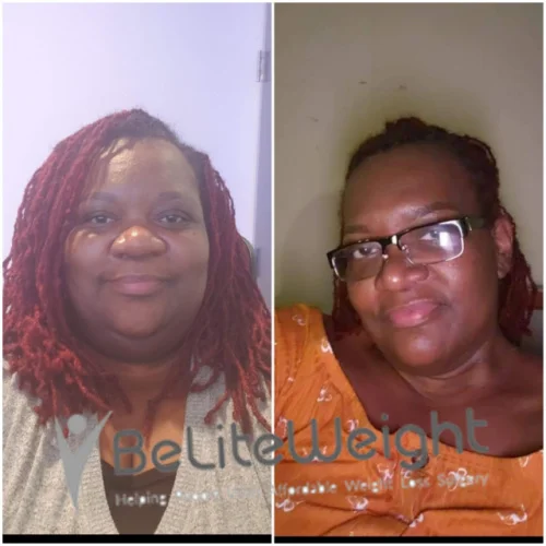 Weight Loss Surgery Gastric Sleeve before and after